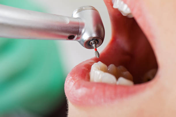 Best Broken or Cracked Tooth Emergency Dentist in Simpsonville, SC